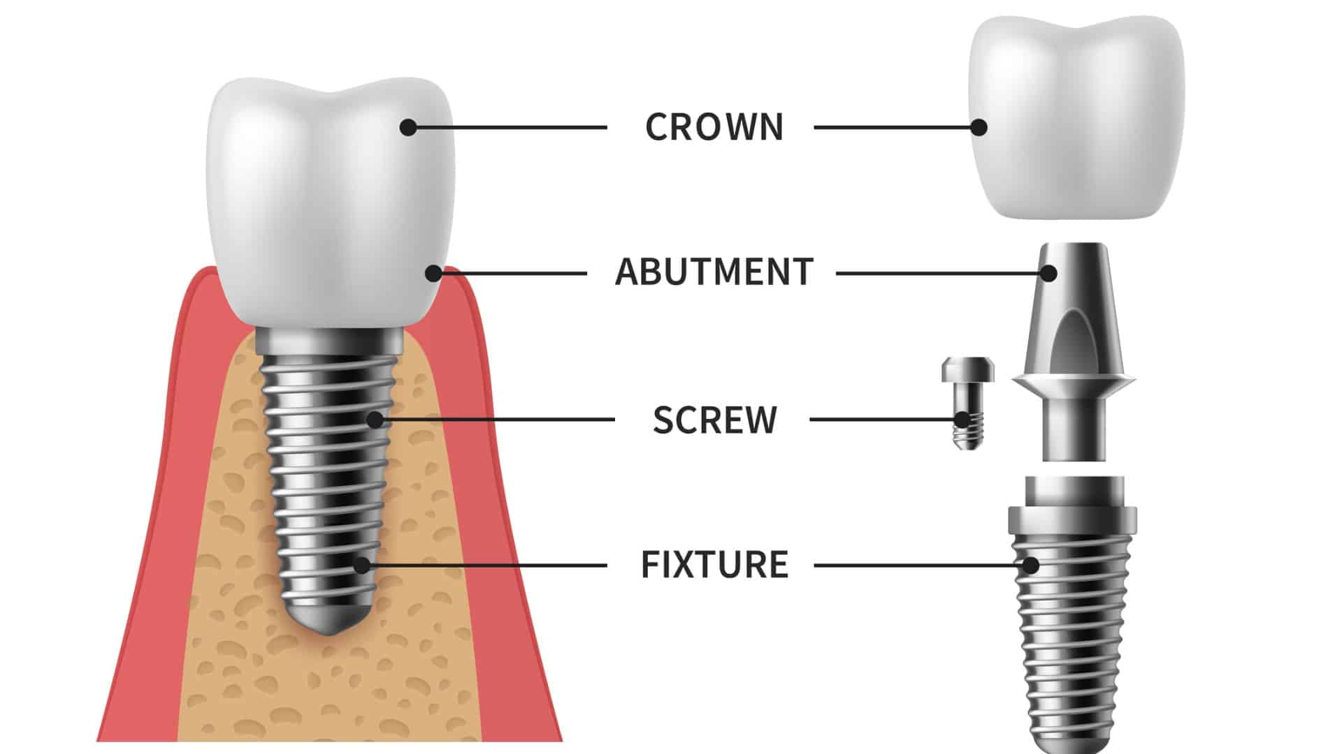 tooth-implant-realistic-implant-structure-pictorial-models-crown-vector-id1251576368 (5) (1)